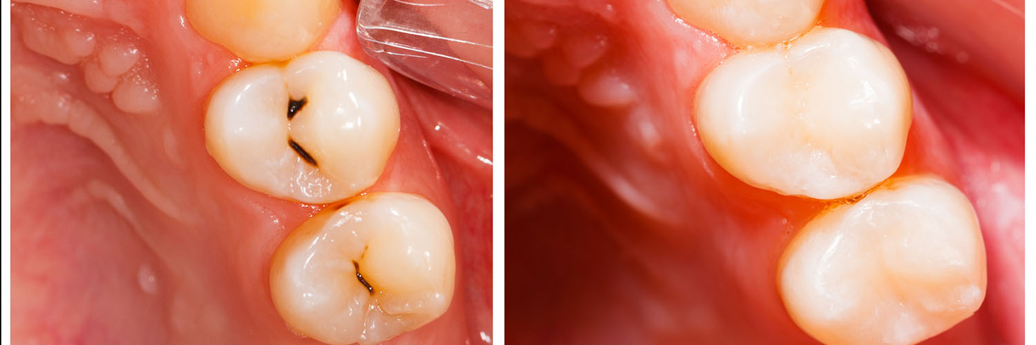 Moudy Dental | Implants   Implant Restorations, All-on-4 reg  and Dentures